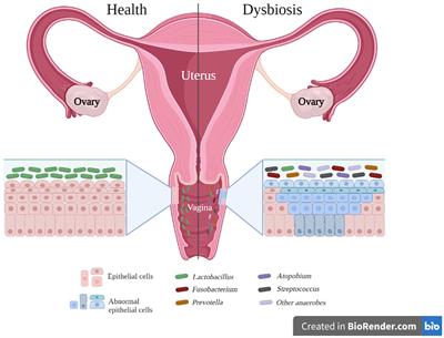 Microbiota changes: the unseen players in cervical cancer progression